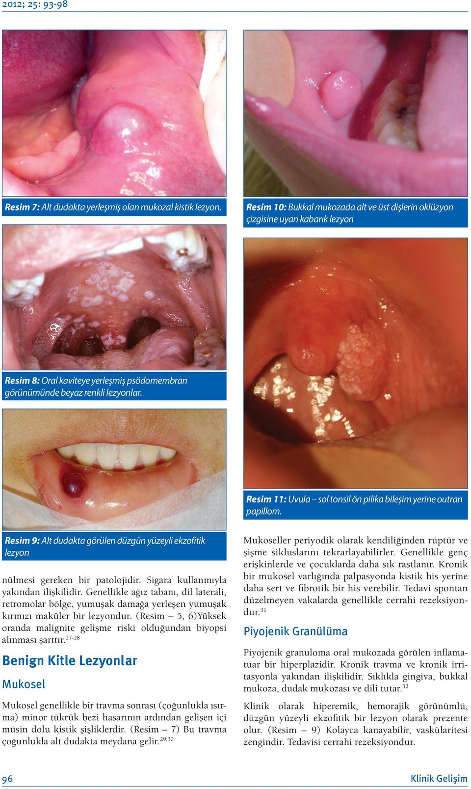 Resim 11: Uvula sol tonsil ön pilika bileşim yerine outran papillom. Resim 9: Alt dudakta görülen düzgün yüzeyli ekzofitik lezyon nülmesi gereken bir patolojidir.