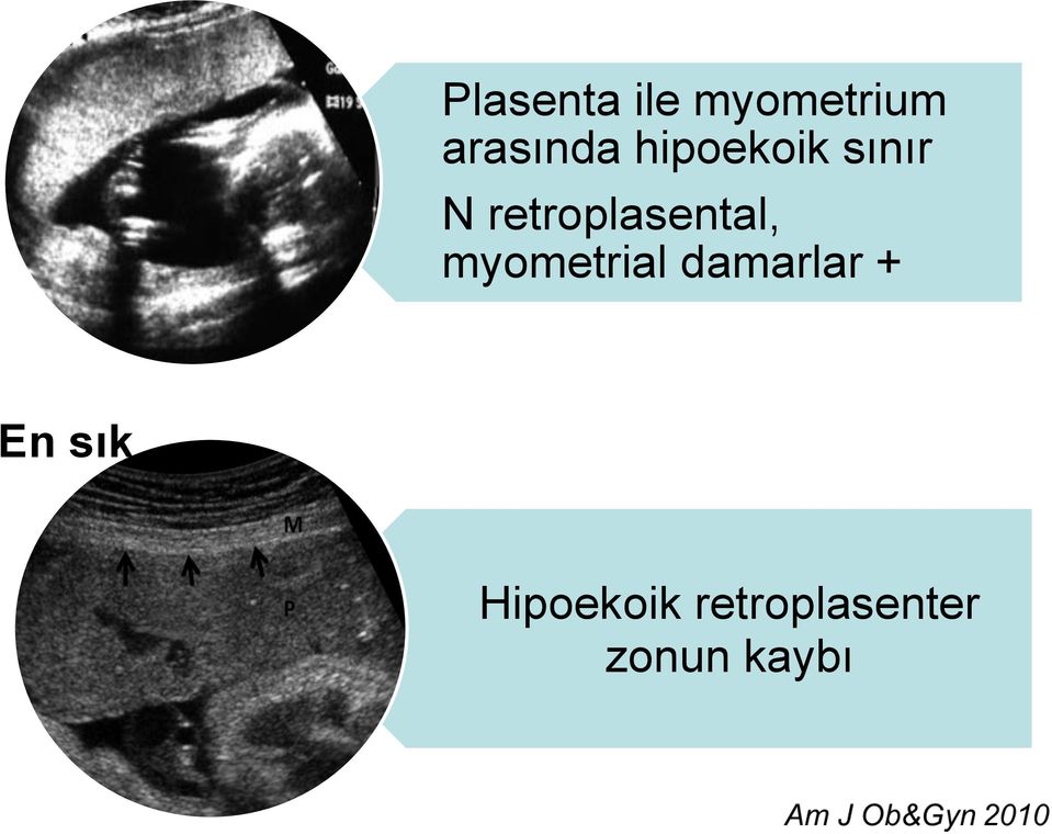 retroplasental, myometrial