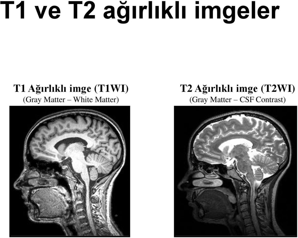 Matter White Matter) T2