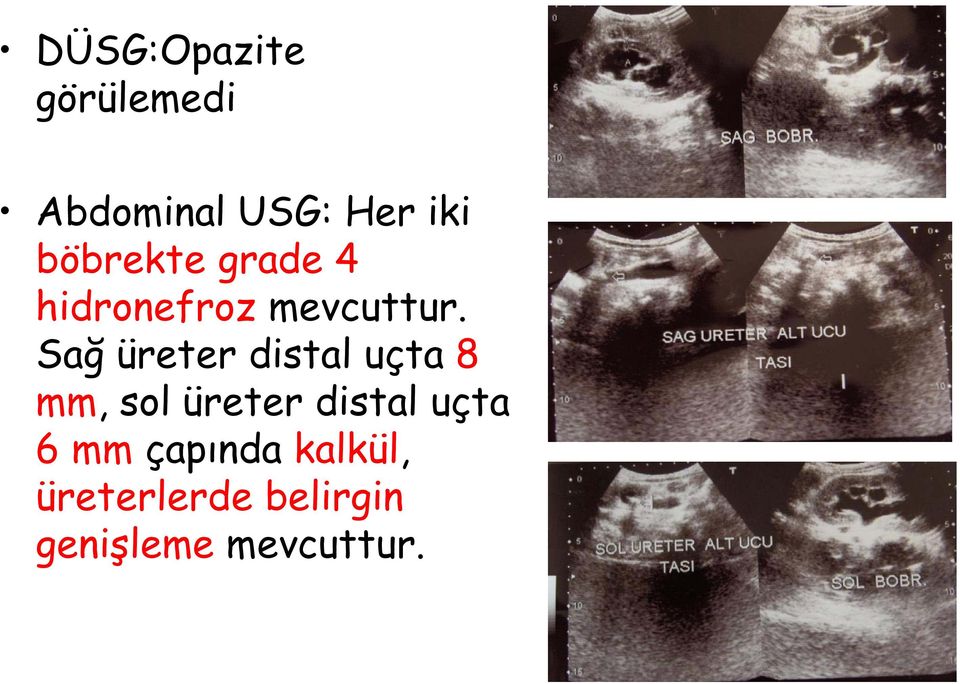 Sağ üreter distal uçta 8 mm, sol üreter distal