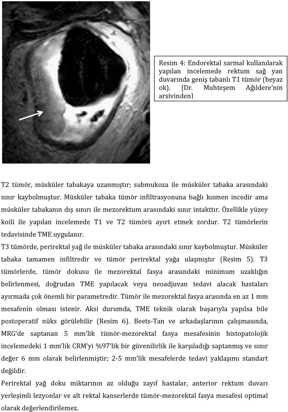 Müsküler tabaka tümör infiltrasyonuna bağlı kısmen incedir ama müsküler tabakanın dış sınırı ile mezorektum arasındaki sınır intakttır.