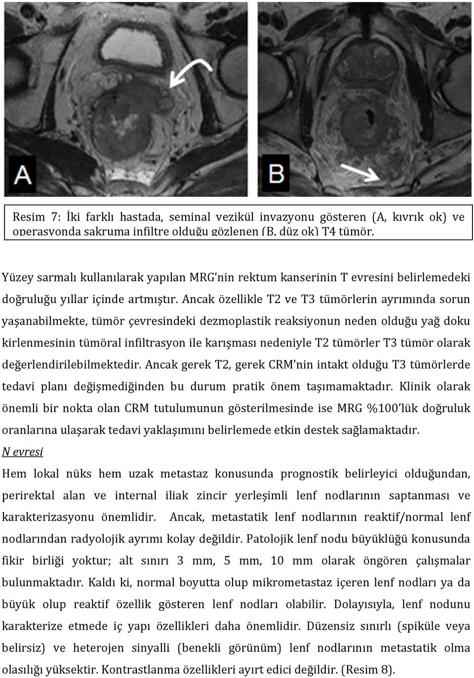 Ancak özellikle T2 ve T3 tümörlerin ayrımında sorun yaşanabilmekte, tümör çevresindeki dezmoplastik reaksiyonun neden olduğu yağ doku kirlenmesinin tümöral infiltrasyon ile karışması nedeniyle T2