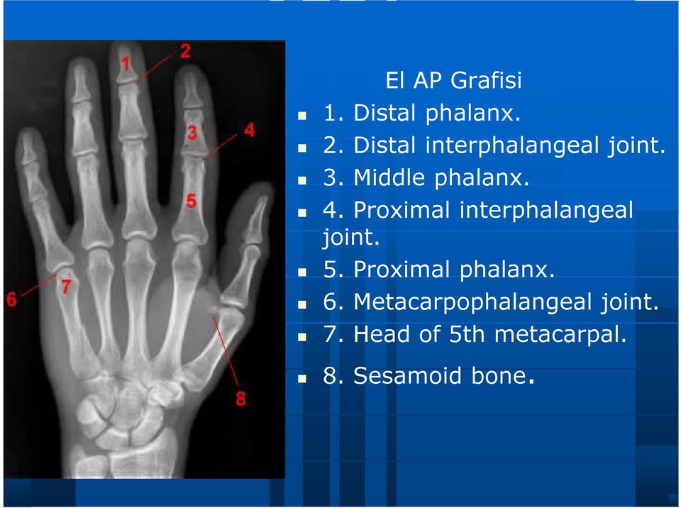 Proximal interphalangeal joint. 5. Proximal phalanx.