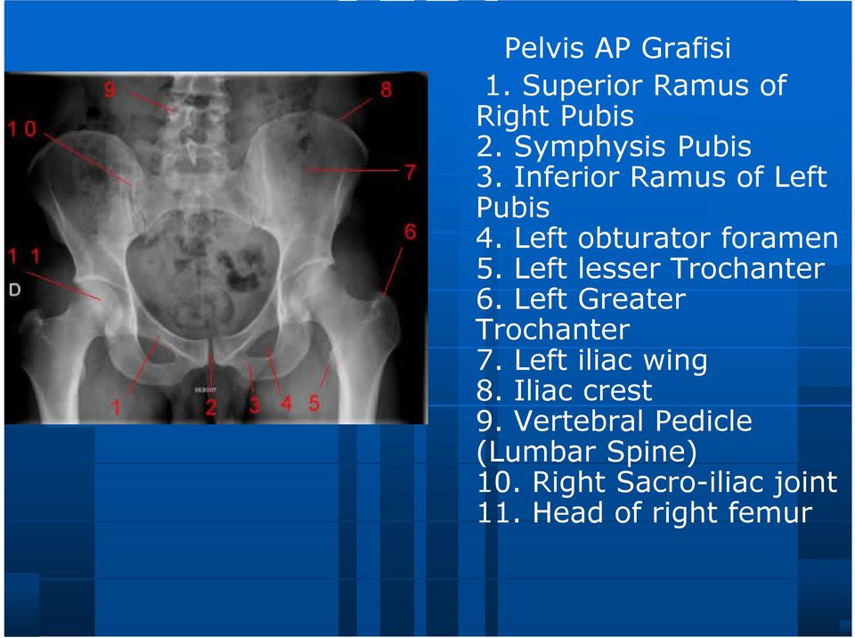 Left lesser Trochanter 6. Left Greater Trochanter 7. Left iliac wing 8.