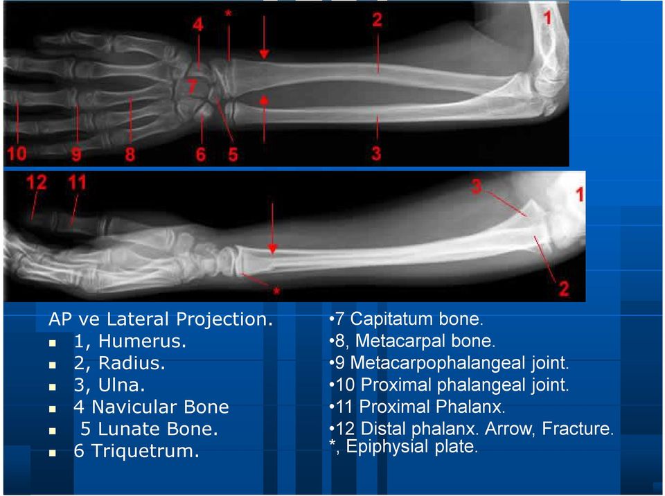 8, Metacarpal bone. 9 Metacarpophalangeal joint.