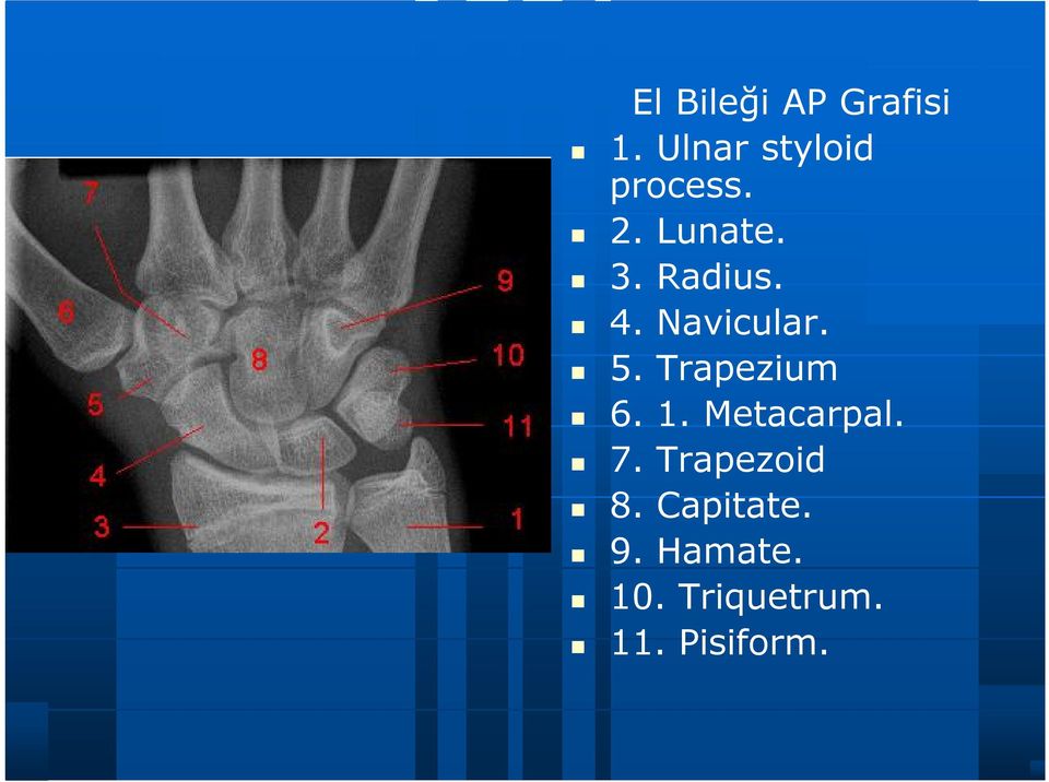 4. Navicular. 5. Trapezium 6. 1. Metacarpal.