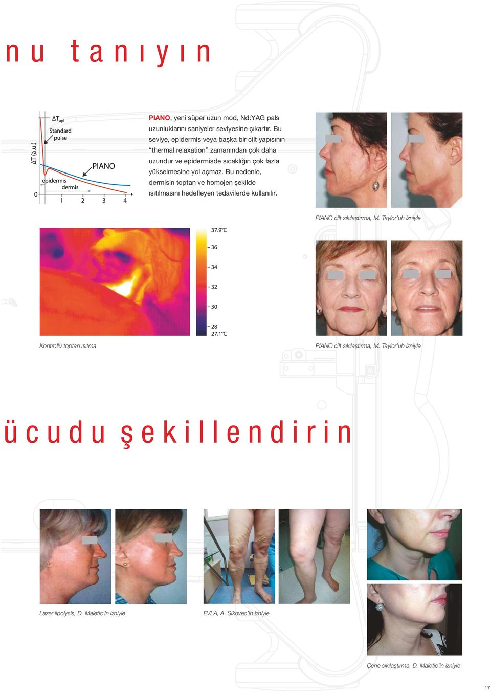 açmaz. Bu nedenle, dermisin toptan ve homojen șekilde ısıtılmasını hedefleyen tedavilerde kullanılır. PIANO cilt sıkılaştırma, M.