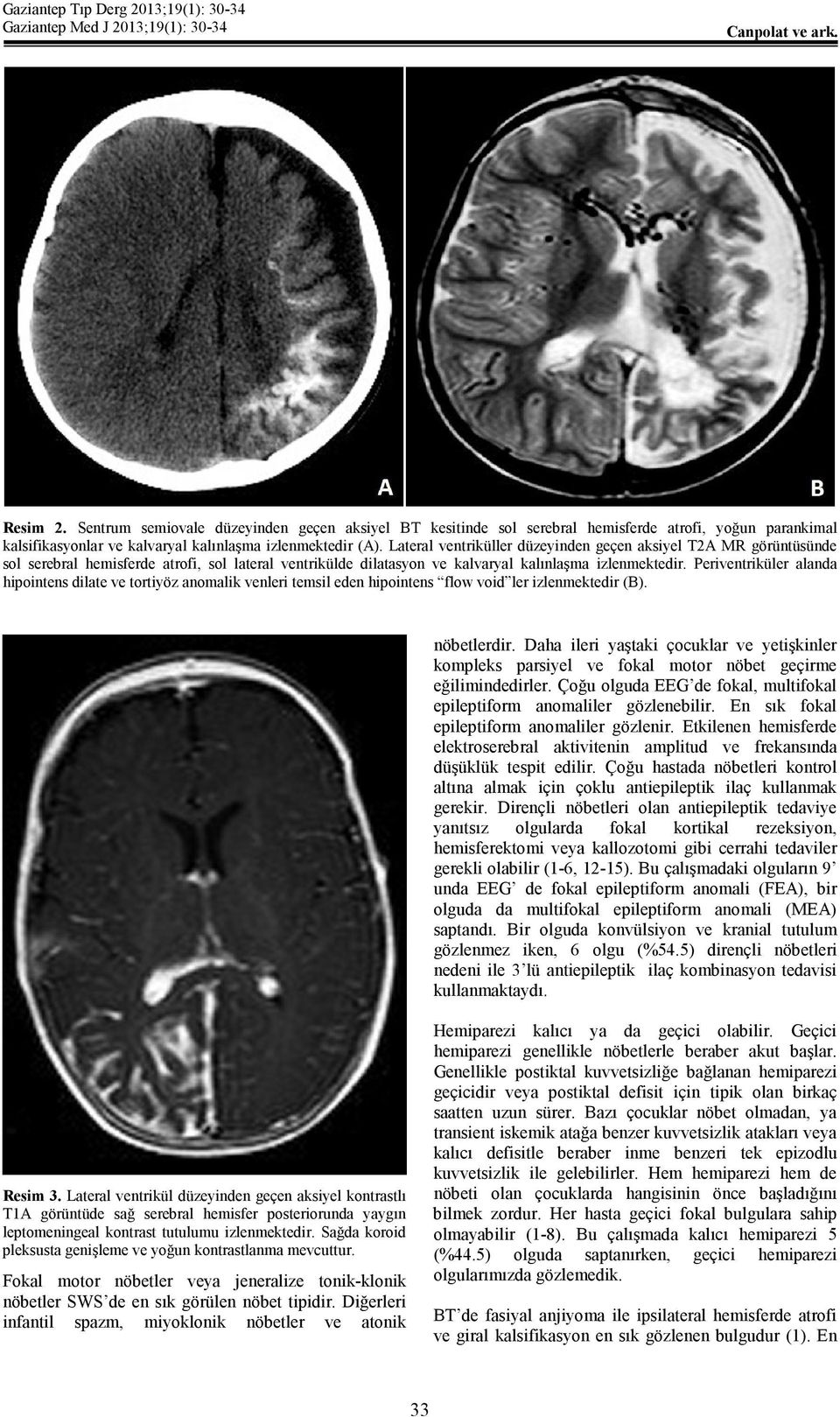 Periventriküler alanda hipointens dilate ve tortiyöz anomalik venleri temsil eden hipointens flow void ler izlenmektedir (B). nöbetlerdir.