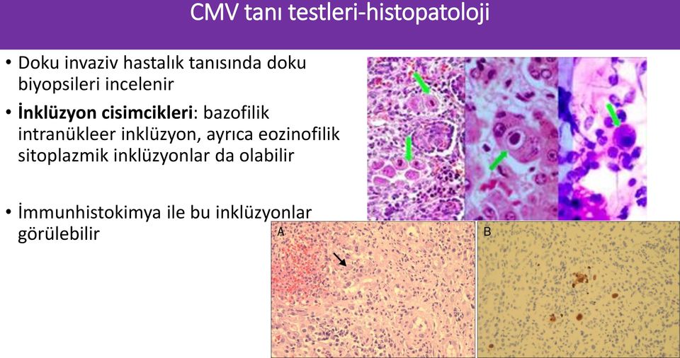 bazofilik intranükleer inklüzyon, ayrıca eozinofilik sitoplazmik