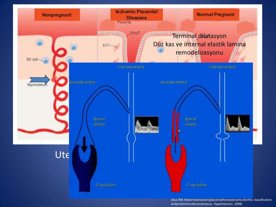 hipoksi Plasental iskemi Sibai BM.