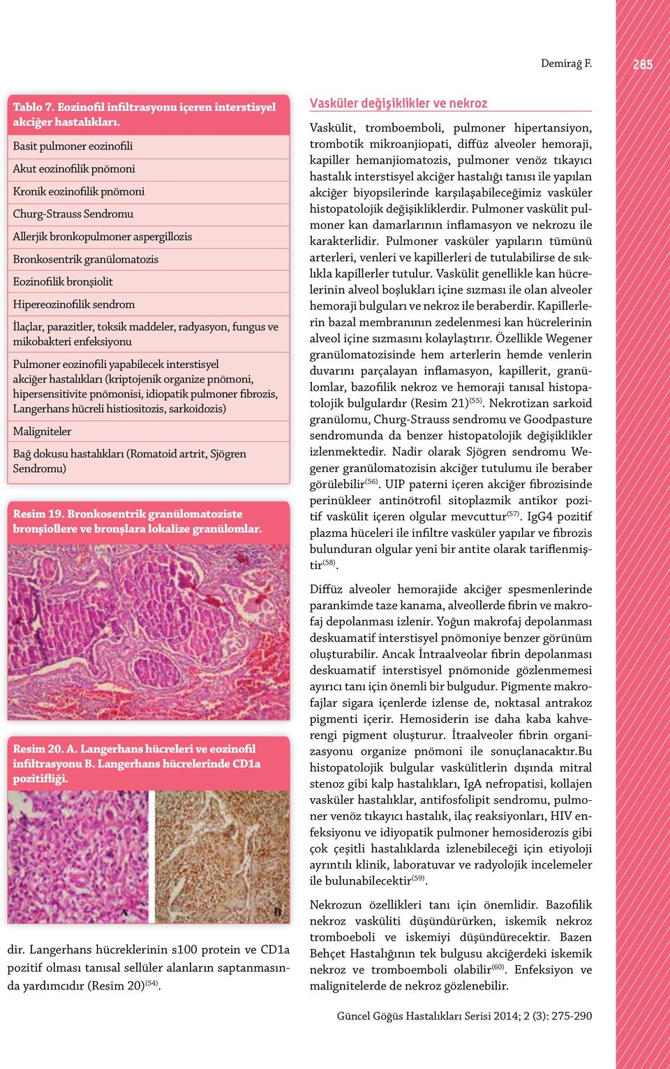 Hipereozinofilik sendrom İlaçlar, parazitler, toksik maddeler, radyasyon, fungus ve mikobakteri enfeksiyonu Pulmoner eozinofili yapabilecek interstisyel akciğer hastalıkları (kriptojenik organize