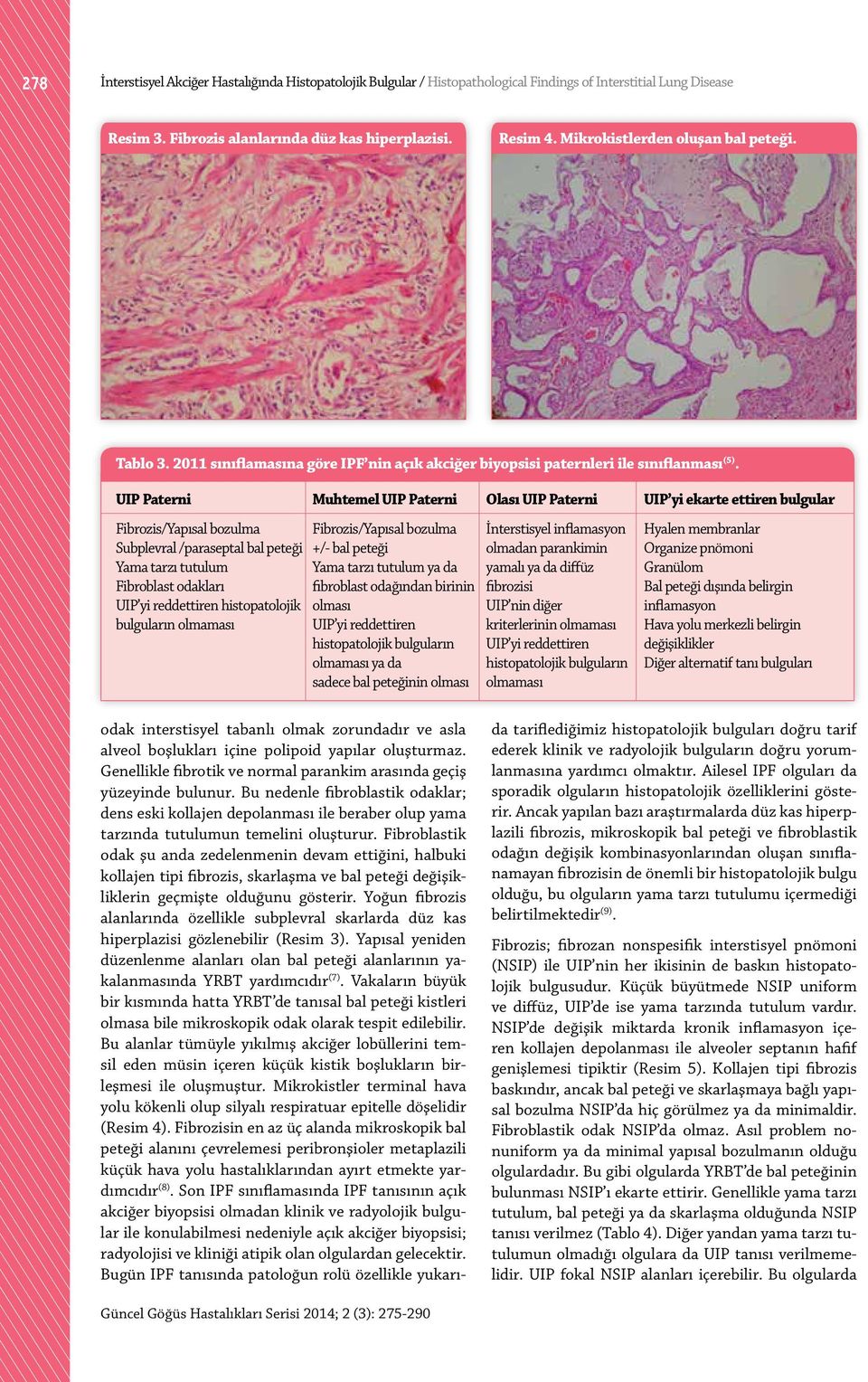 UIP Paterni Muhtemel UIP Paterni Olası UIP Paterni UIP yi ekarte ettiren bulgular Fibrozis/Yapısal bozulma Fibrozis/Yapısal bozulma İnterstisyel inflamasyon Hyalen membranlar Subplevral /paraseptal