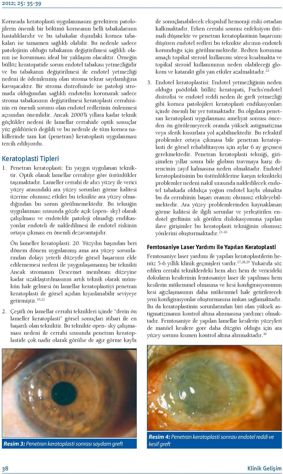 Örneğin büllöz keratopatide sorun endotel tabakası yetmezliğidir ve bu tabakanın değiştirilmesi ile endotel yetmezliği nedeni ile ödemlenmiş olan stroma tekrar saydamlığına kavuşacaktır.