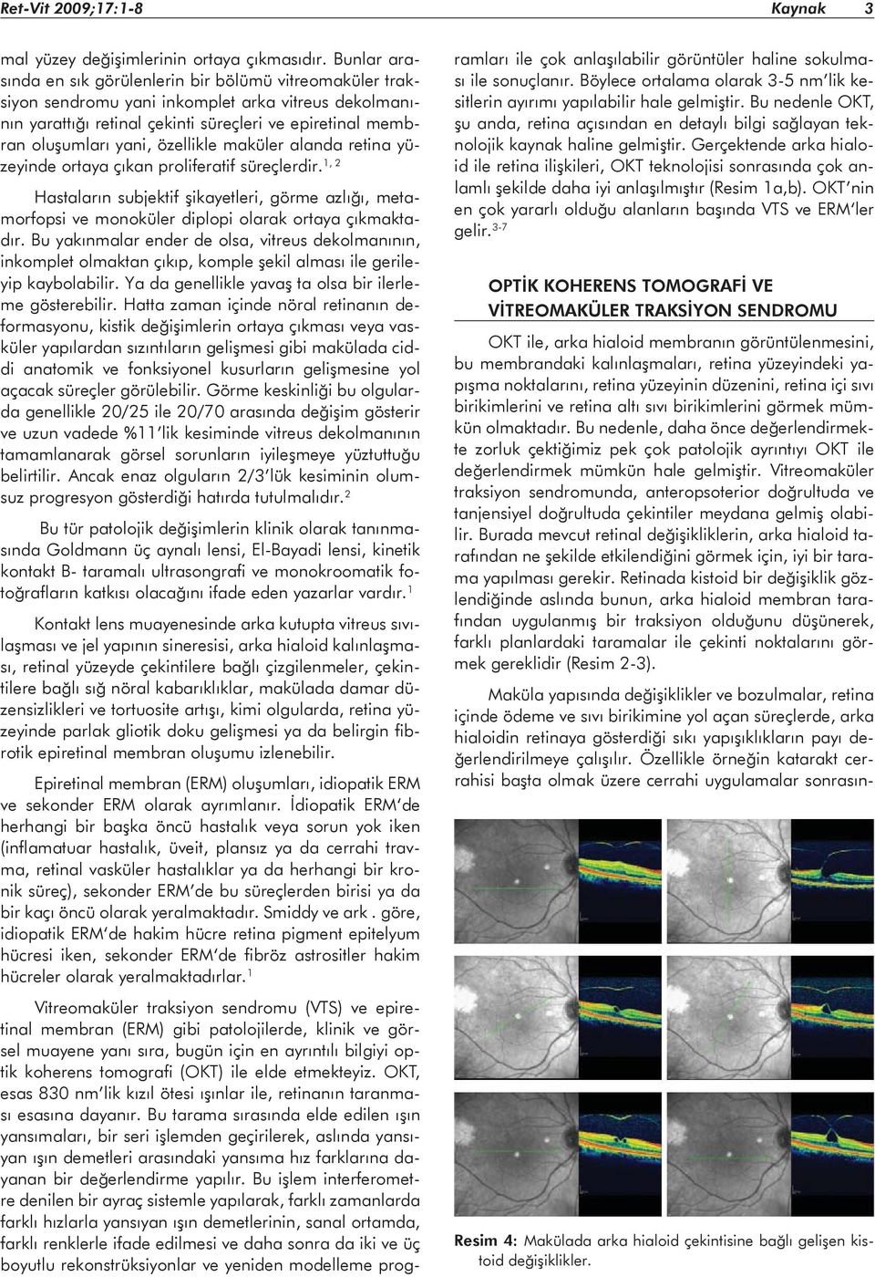 özellikle maküler alanda retina yüzeyinde ortaya çıkan proliferatif süreçlerdir. 1, 2 Hastaların subjektif şikayetleri, görme azlığı, metamorfopsi ve monoküler diplopi olarak ortaya çıkmaktadır.