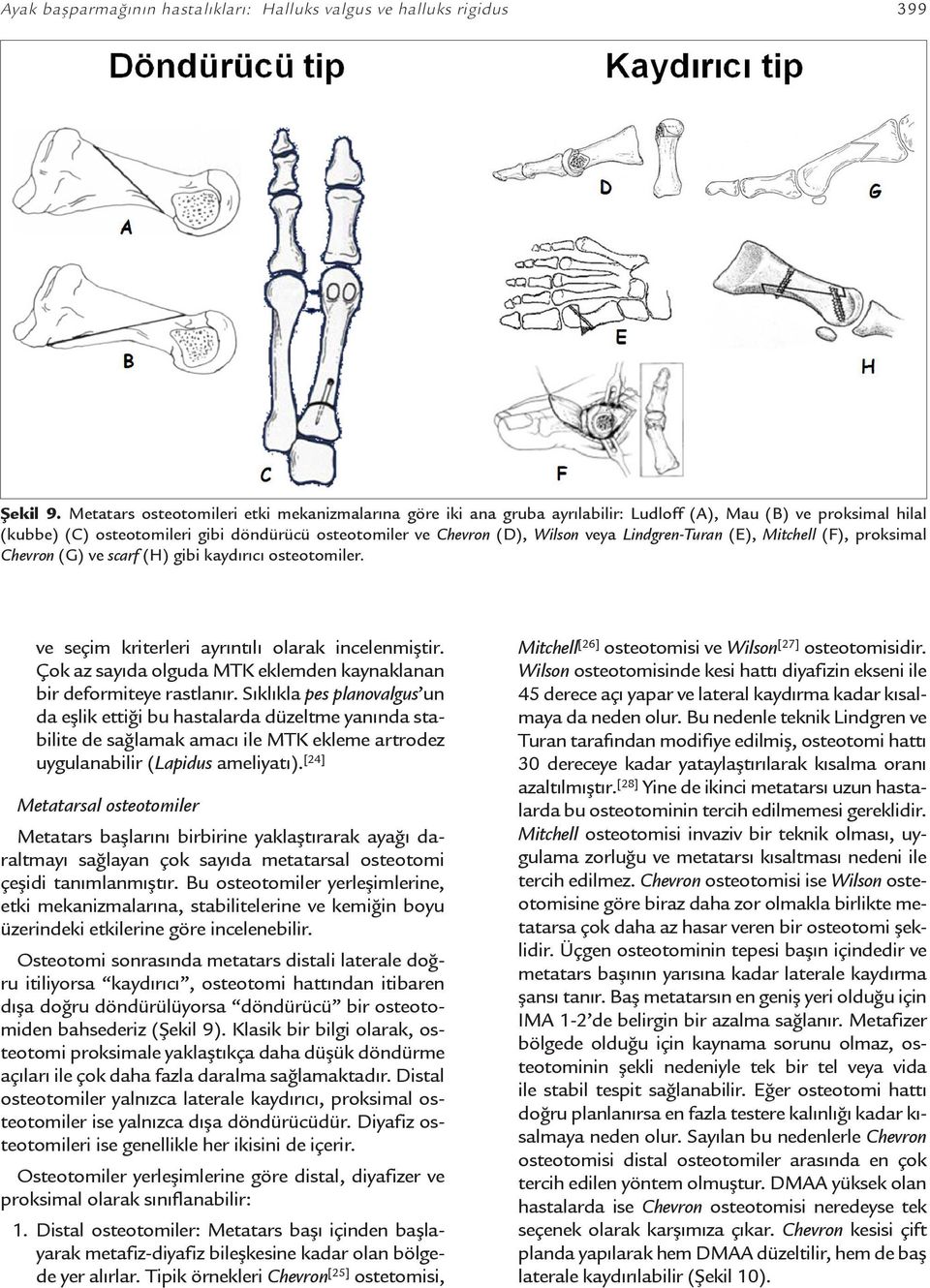 Lindgren-Turan (E), Mitchell (F), proksimal Chevron (G) ve scarf (H) gibi kaydırıcı osteotomiler. ve seçim kriterleri ayrıntılı olarak incelenmiştir.