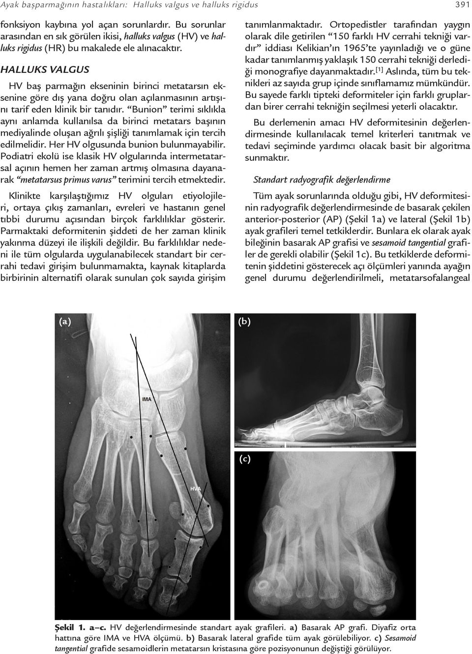 HALLUKS VALGUS HV baş parmağın ekseninin birinci metatarsın eksenine göre dış yana doğru olan açılanmasının artışını tarif eden klinik bir tanıdır.