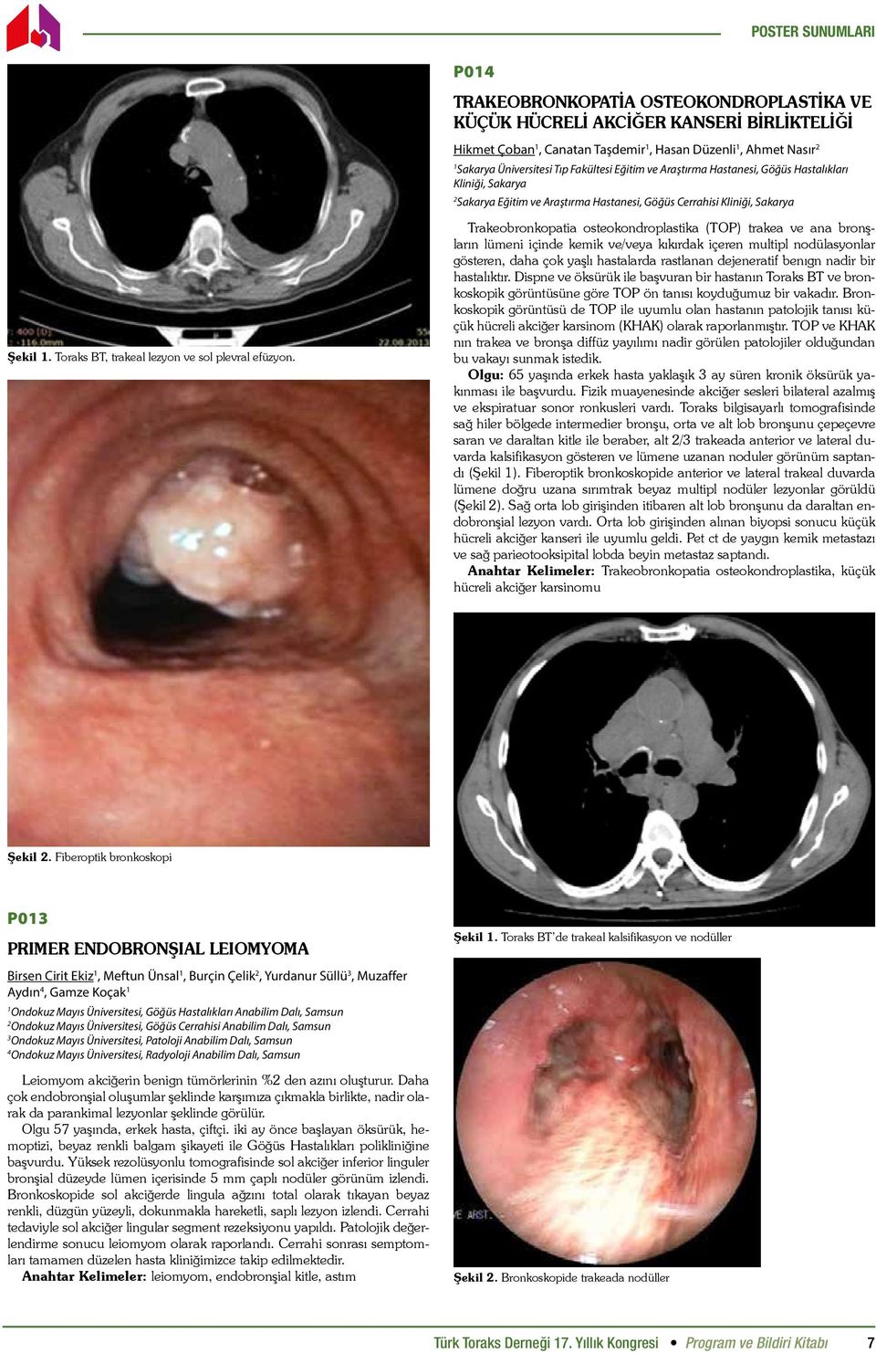 Trakeobronkopatia osteokondroplastika (TOP) trakea ve ana bronşların lümeni içinde kemik ve/veya kıkırdak içeren multipl nodülasyonlar gösteren, daha çok yaşlı hastalarda rastlanan dejeneratif benıgn