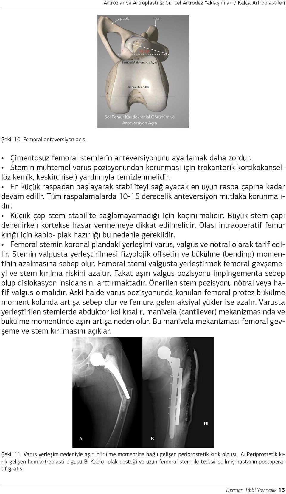 En küçük raspadan başlayarak stabiliteyi sağlayacak en uyun raspa çapına kadar devam edilir. Tüm raspalamalarda 10-15 derecelik anteversiyon mutlaka korunmalıdır.