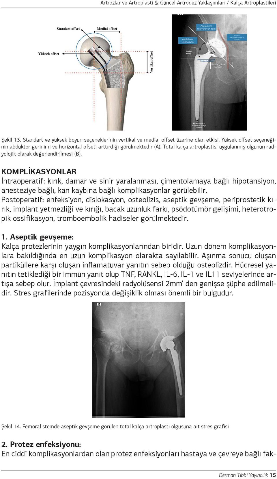 KOMPLİKASYONLAR İntraoperatif: kırık, damar ve sinir yaralanması, çimentolamaya bağlı hipotansiyon, anesteziye bağlı, kan kaybına bağlı komplikasyonlar görülebilir.