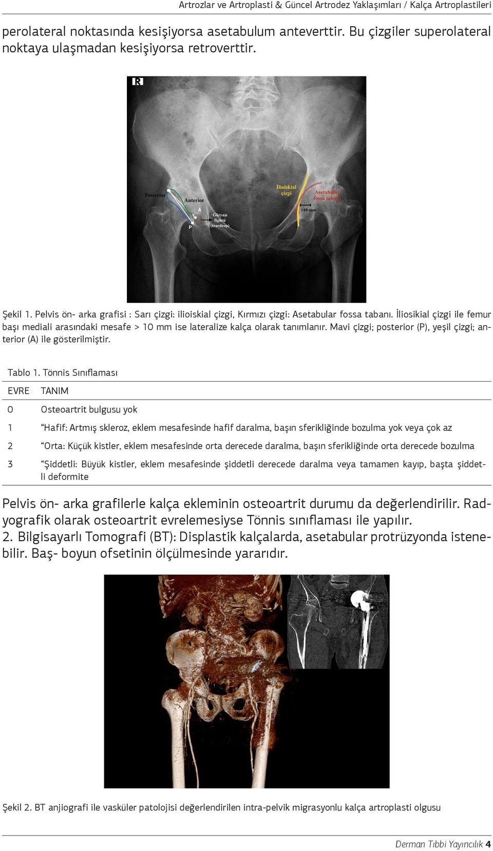 İliosikial çizgi ile femur başı mediali arasındaki mesafe > 10 mm ise lateralize kalça olarak tanımlanır. Mavi çizgi; posterior (P), yeşil çizgi; anterior (A) ile gösterilmiştir. Tablo 1.