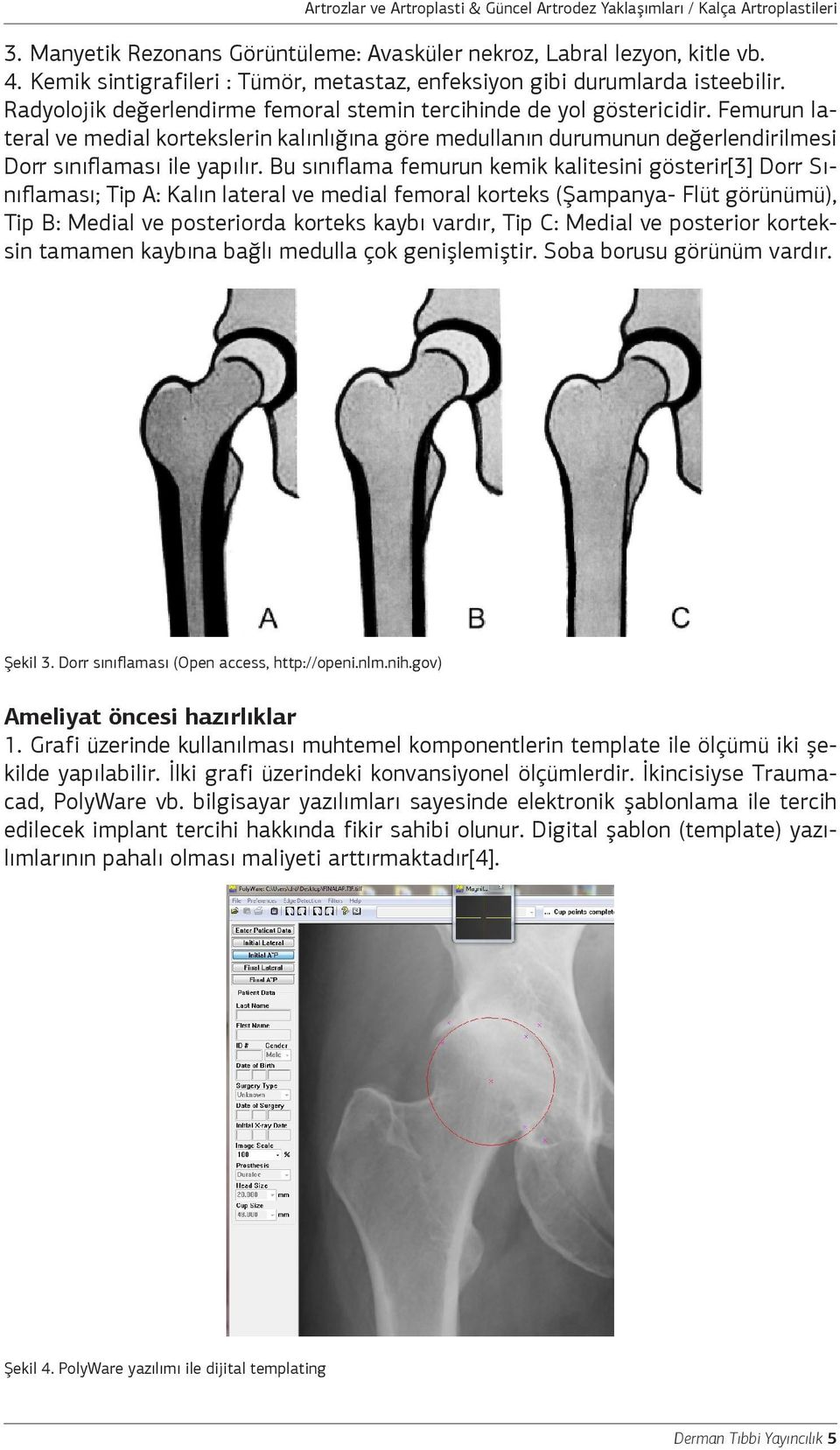 Bu sınıflama femurun kemik kalitesini gösterir[3] Dorr Sınıflaması; Tip A: Kalın lateral ve medial femoral korteks (Şampanya- Flüt görünümü), Tip B: Medial ve posteriorda korteks kaybı vardır, Tip C: