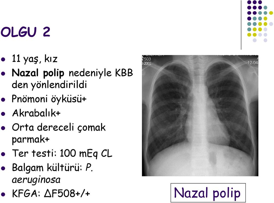 dereceli çomak parmak+ Ter testi: 100 meq CL