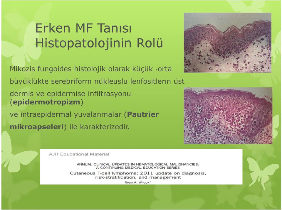 lenfositlerin üst dermis ve epidermise infiltrasyonu