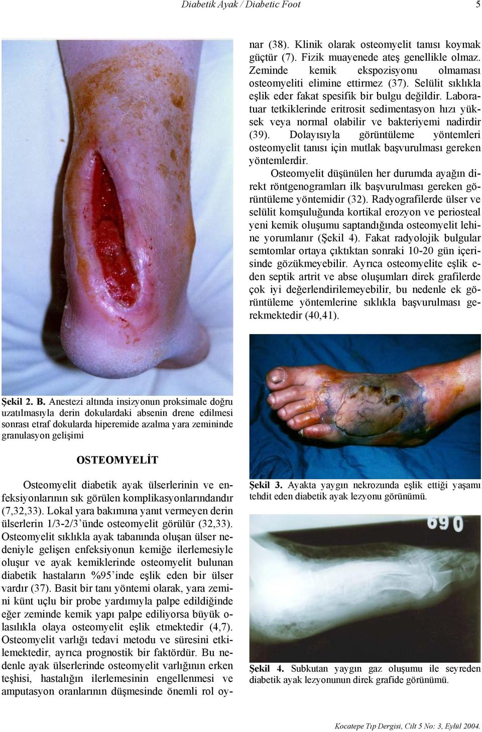 Osteomyelit sıklıkla ayak tabanında oluşan ülser nedeniyle gelişen enfeksiyonun kemiğe ilerlemesiyle oluşur ve ayak kemiklerinde osteomyelit bulunan diabetik hastaların %95 inde eşlik eden bir ülser