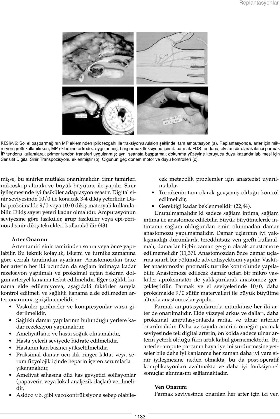 parmak FDS tendonu, ekstansör olarak ikinci parmak P tendonu kullan larak primer tendon transferi uygulanm fl; ayn seansta baflparmak dokunma yüzeyine koruyucu duyu kazand r labilmesi için Sensitif