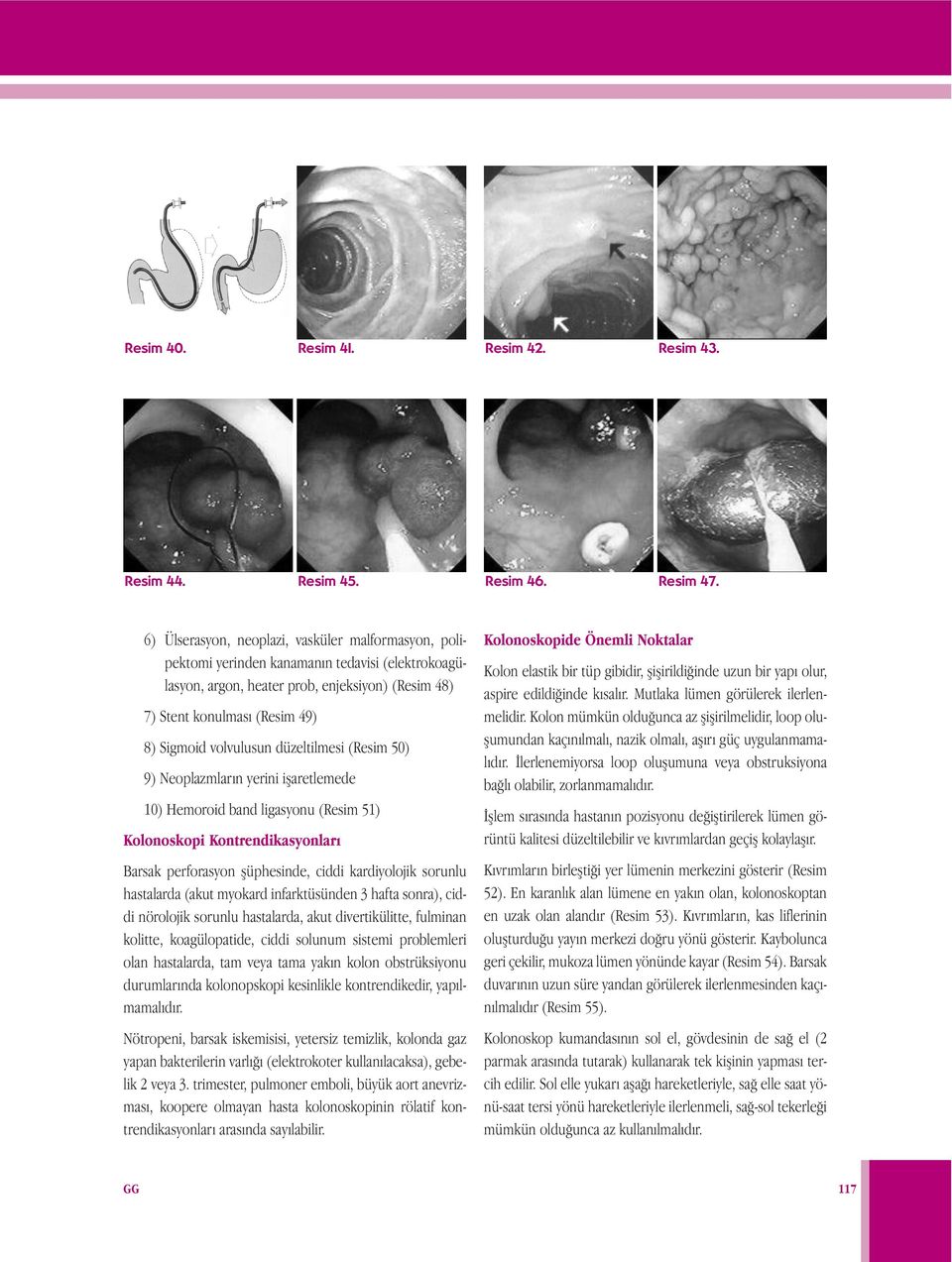 volvulusun düzeltilmesi (Resim 50) 9) Neoplazmların yerini işaretlemede 10) Hemoroid band ligasyonu (Resim 51) Kolonoskopi Kontrendikasyonları Barsak perforasyon şüphesinde, ciddi kardiyolojik