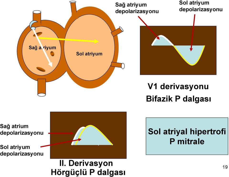 atrium depolarizasyonu Sol atriyum depolarizasyonu II.