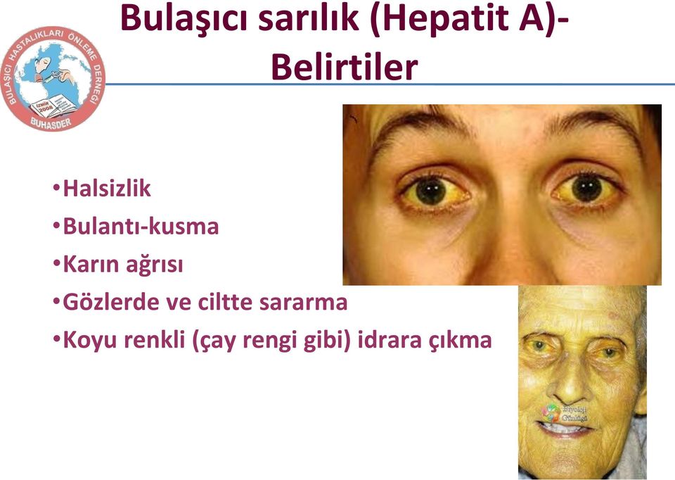 Karın ağrısı Gözlerde ve ciltte