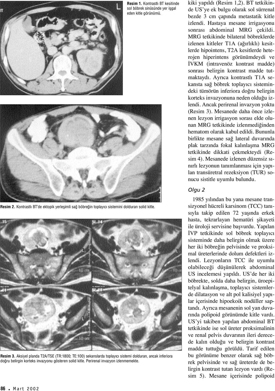 kiki yap ld (Resim 1,2). BT tetkikinde US ye ek bulgu olarak sol sürrenal bezde 3 cm çap nda metastatik kitle izlendi. Hastaya mesane irrigasyonu sonras abdominal MRG çekildi.