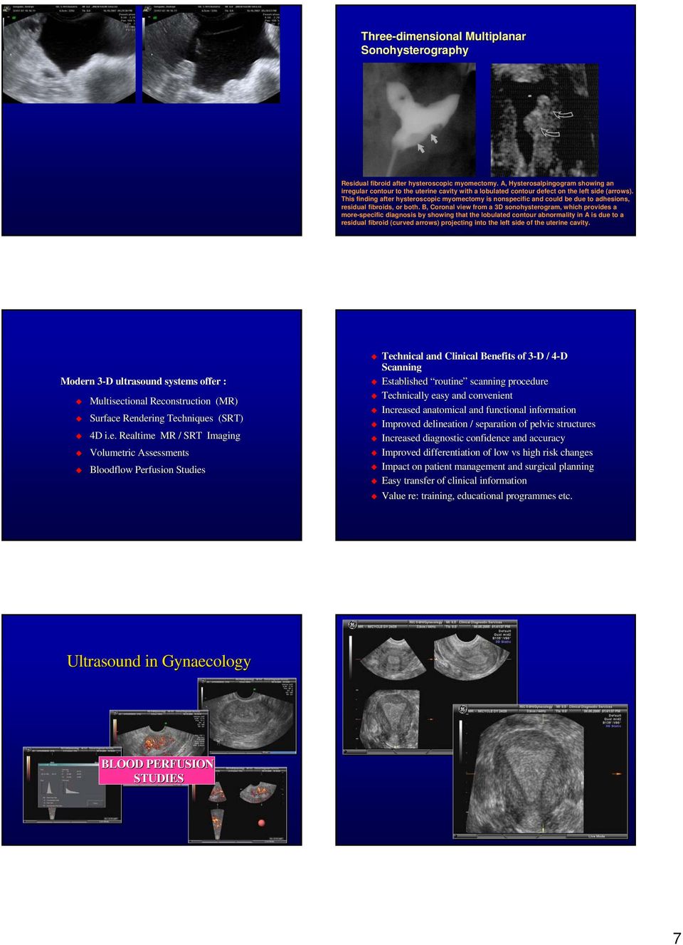 This finding after hysteroscopic myomectomy is nonspecific and could be due to adhesions, residual fibroids, or both.