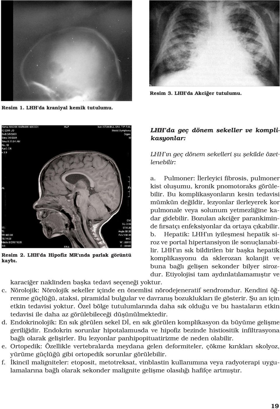 Bu komplikasyonlar n kesin tedavisi mümkün de ildir, lezyonlar ilerleyerek kor pulmonale veya solunum yetmezli ine kadar gidebilir.