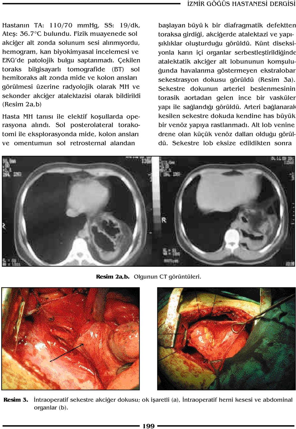 Çekilen toraks bilgisayarl tomografide (BT) sol hemitoraks alt zonda mide ve kolon anslar görülmesi üzerine radyolojik olarak MH ve sekonder akci er atalektazisi olarak bildirildi (Resim 2a,b) Hasta