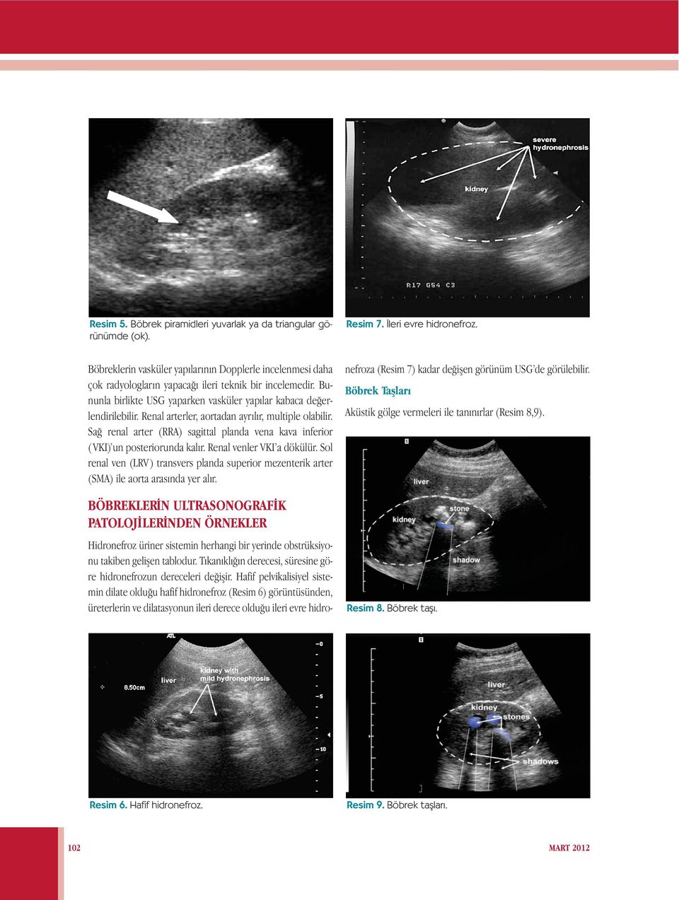 Renal arterler, aortadan ayrılır, multiple olabilir. Sağ renal arter (RRA) sagittal planda vena kava inferior ( VKI) un posteriorunda kalır. Renal venler VKI a dökülür.