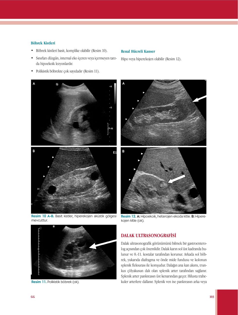 B: Hiperekojen kitle (ok). Resim 11. Polikistik böbrek (ok). DALAK ULTRASONOGRAFİSİ Dalak ultrasonografik görünümünü bilmek bir gastroenterolog açısından çok önemlidir.