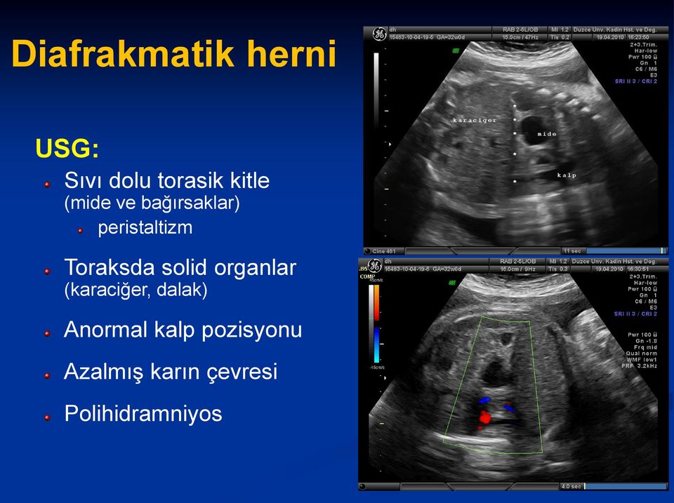 Toraksda solid organlar (karaciğer, dalak)