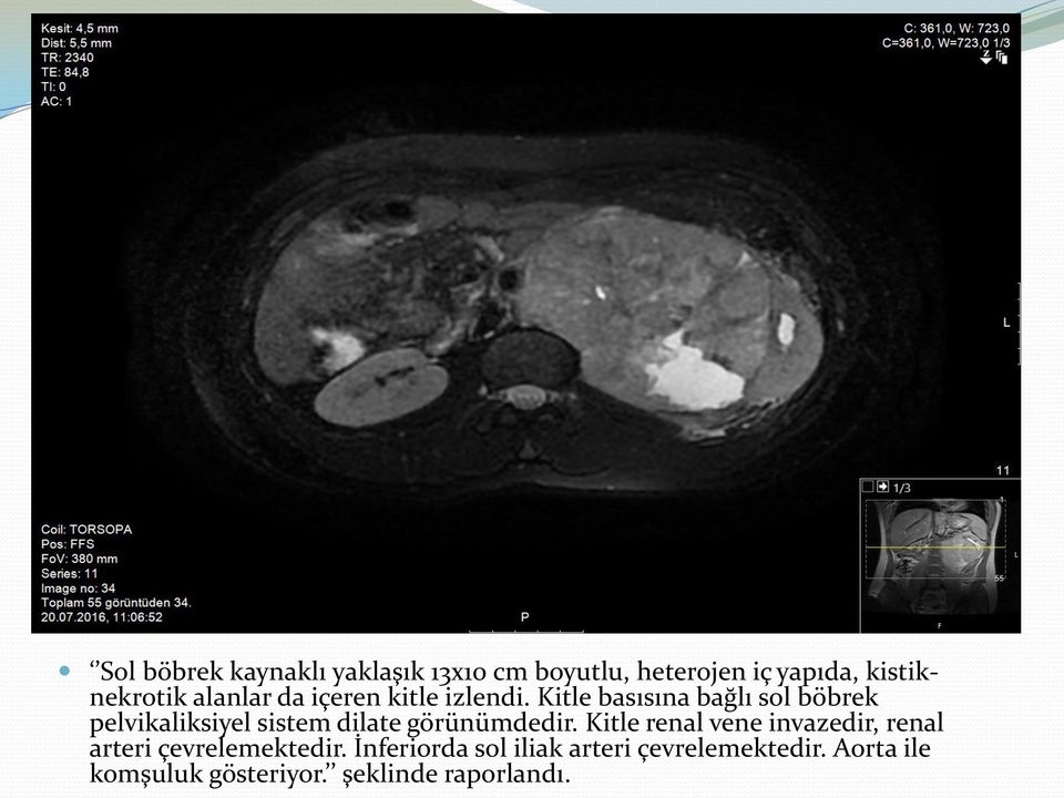 Kitle basısına bağlı sol böbrek pelvikaliksiyel sistem dilate görünümdedir.