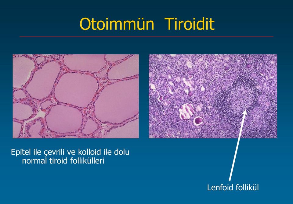 ile dolu normal tiroid