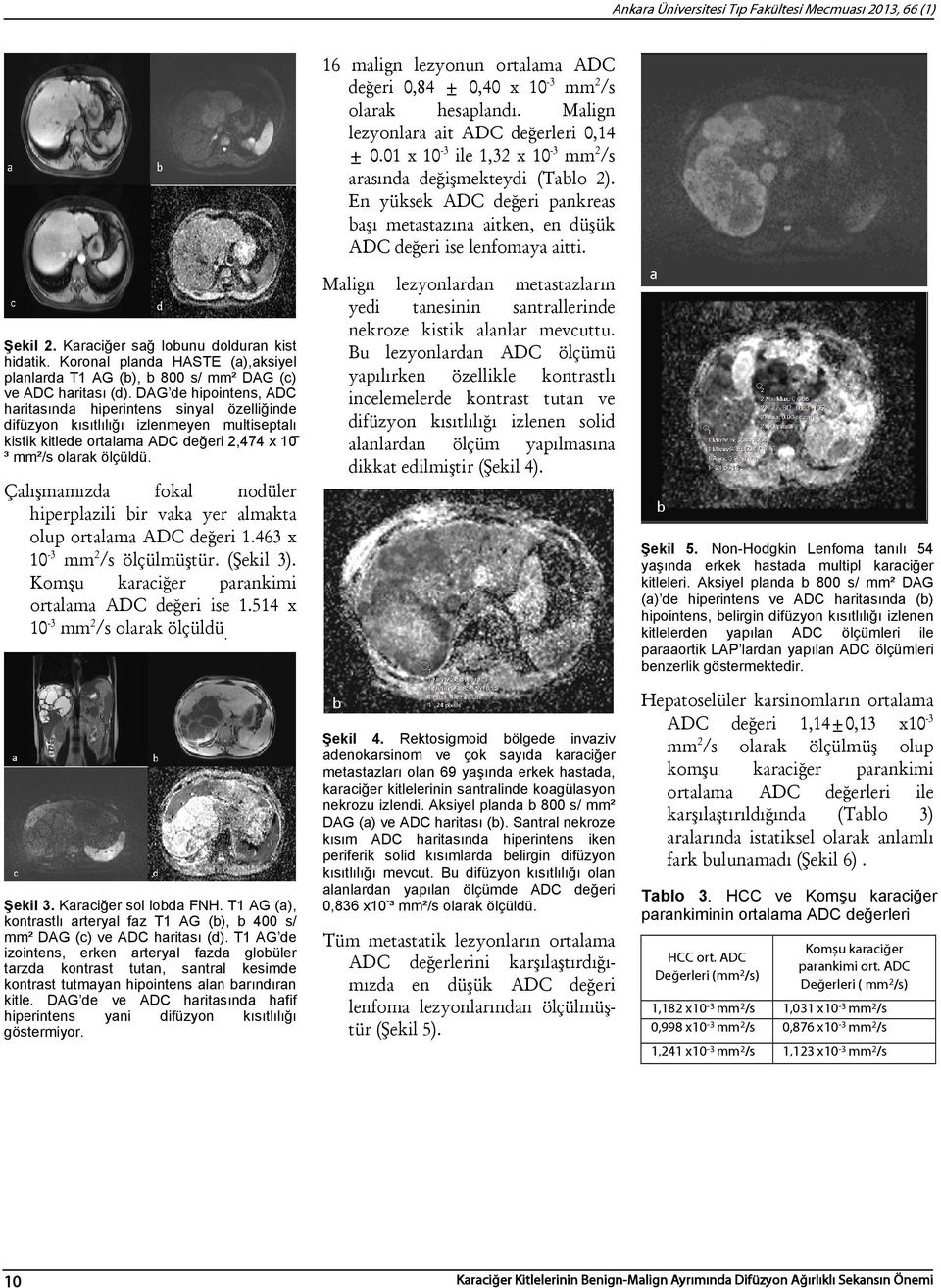 Karaciğer sağ lobunu dolduran kist hidatik. Koronal planda HASTE (a),aksiyel planlarda T1 AG (b), b 800 s/ mm² DAG (c) ve ADC haritası (d).