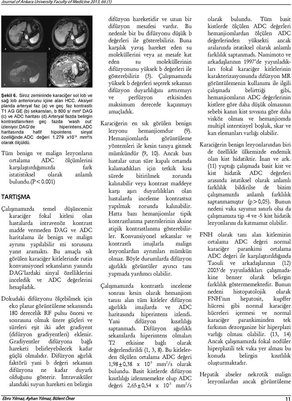 dag de hiperintens,adc haritasında hafif hipointens sinyal özelliğinde.adc değeri 1.279 x10 - ³ mm²/s olarak ölçüldü.