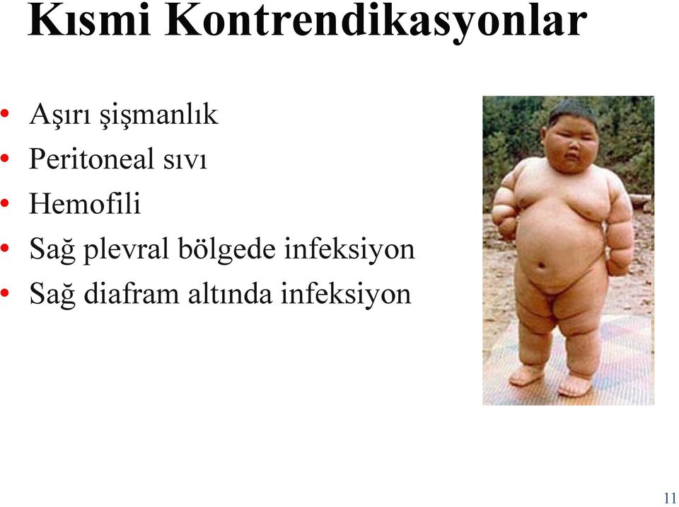 Hemofili Sağ plevral bölgede