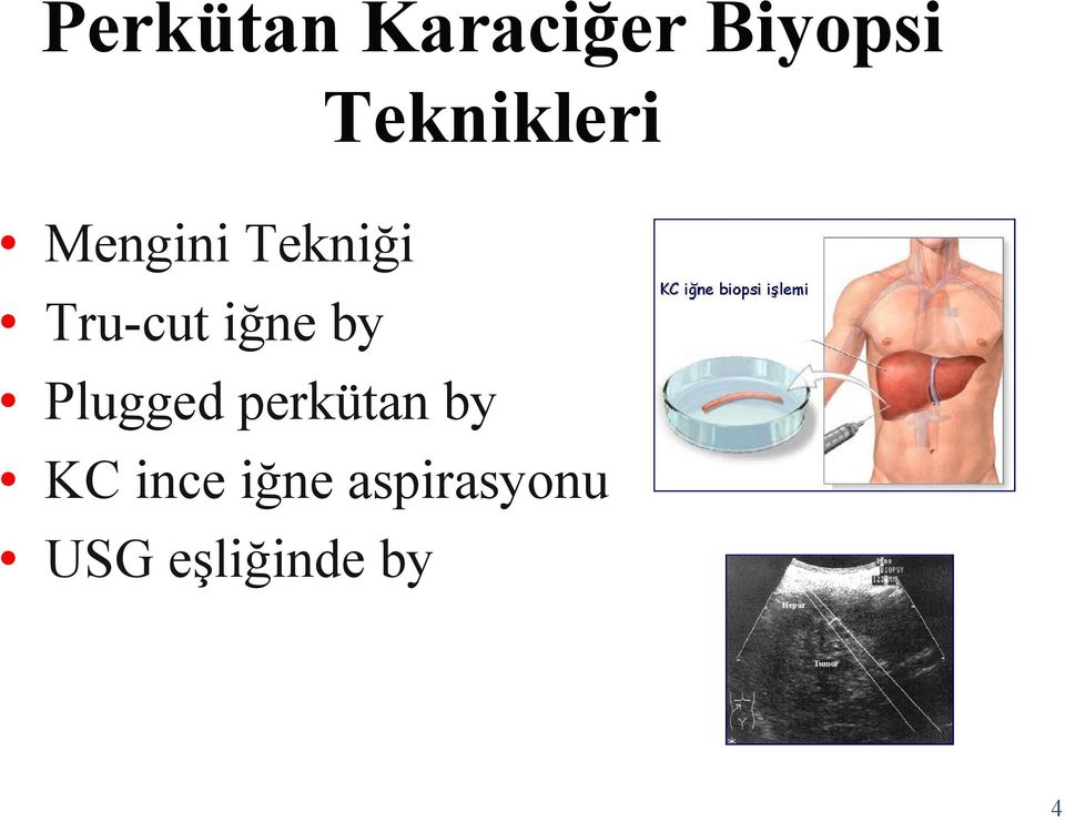 Tru-cut iğne by Plugged perkütan