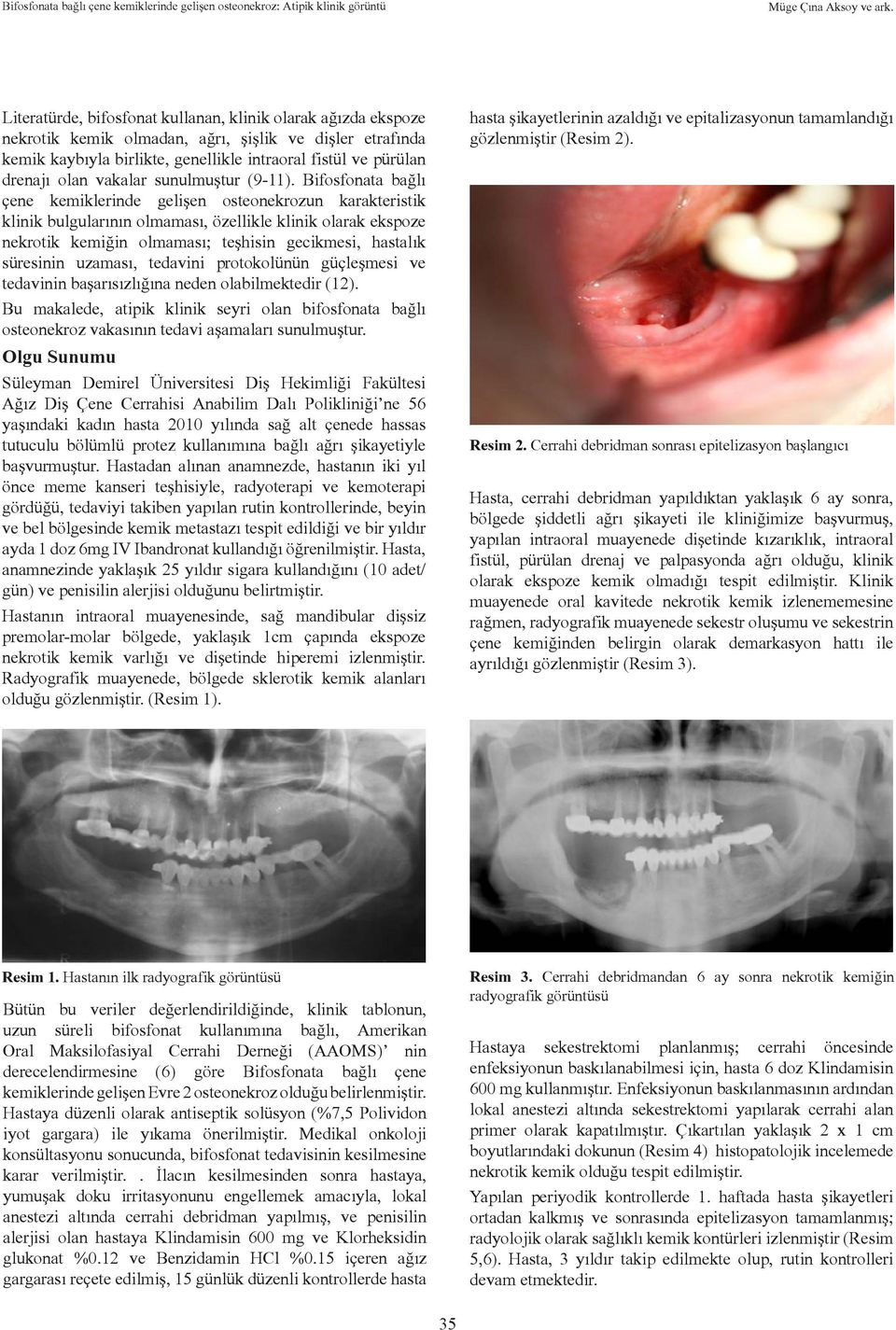 Bifosfonata bağlı çene kemiklerinde gelişen osteonekrozun karakteristik klinik bulgularının olmaması, özellikle klinik olarak ekspoze nekrotik kemiğin olmaması; teşhisin gecikmesi, hastalık süresinin