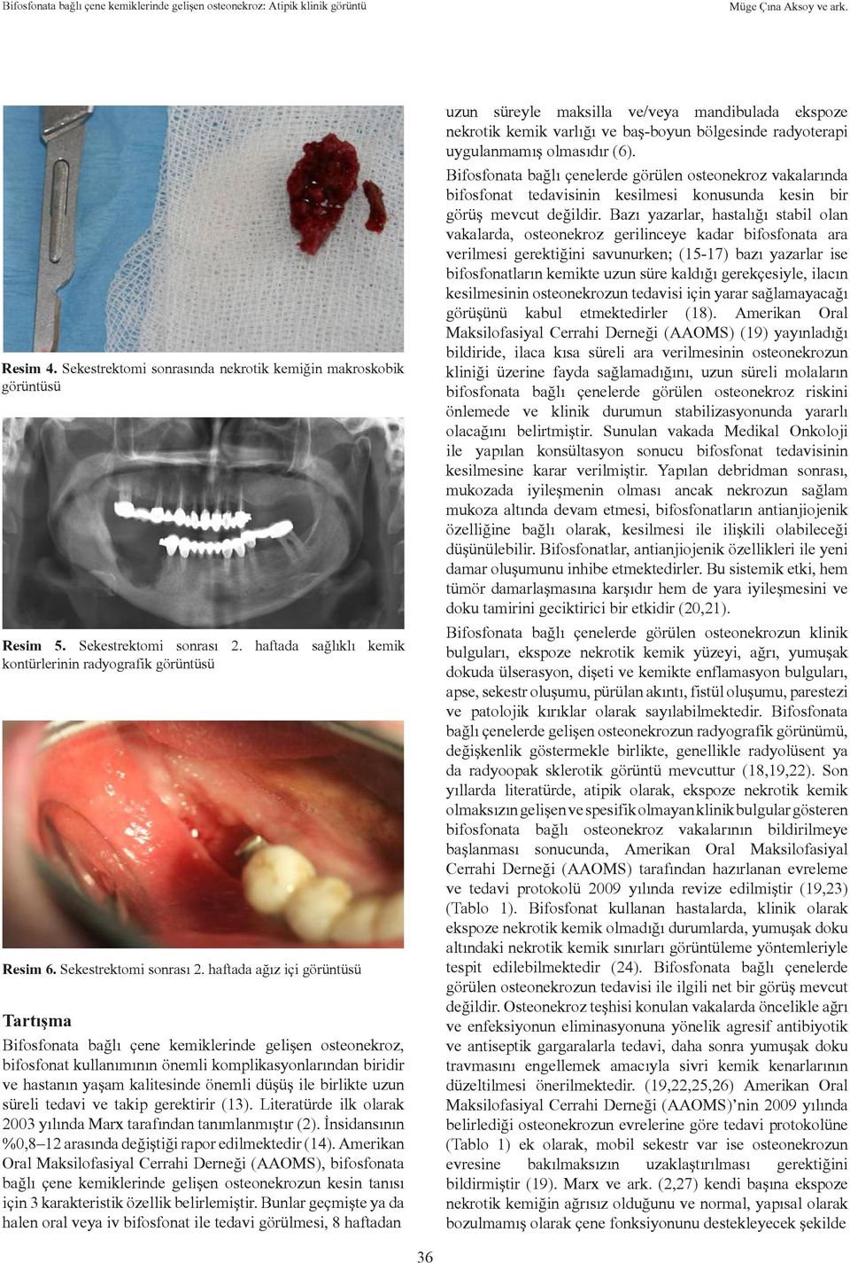haftada ağız içi görüntüsü Tartışma Bifosfonata bağlı çene kemiklerinde gelişen osteonekroz, bifosfonat kullanımının önemli komplikasyonlarından biridir ve hastanın yaşam kalitesinde önemli düşüş ile