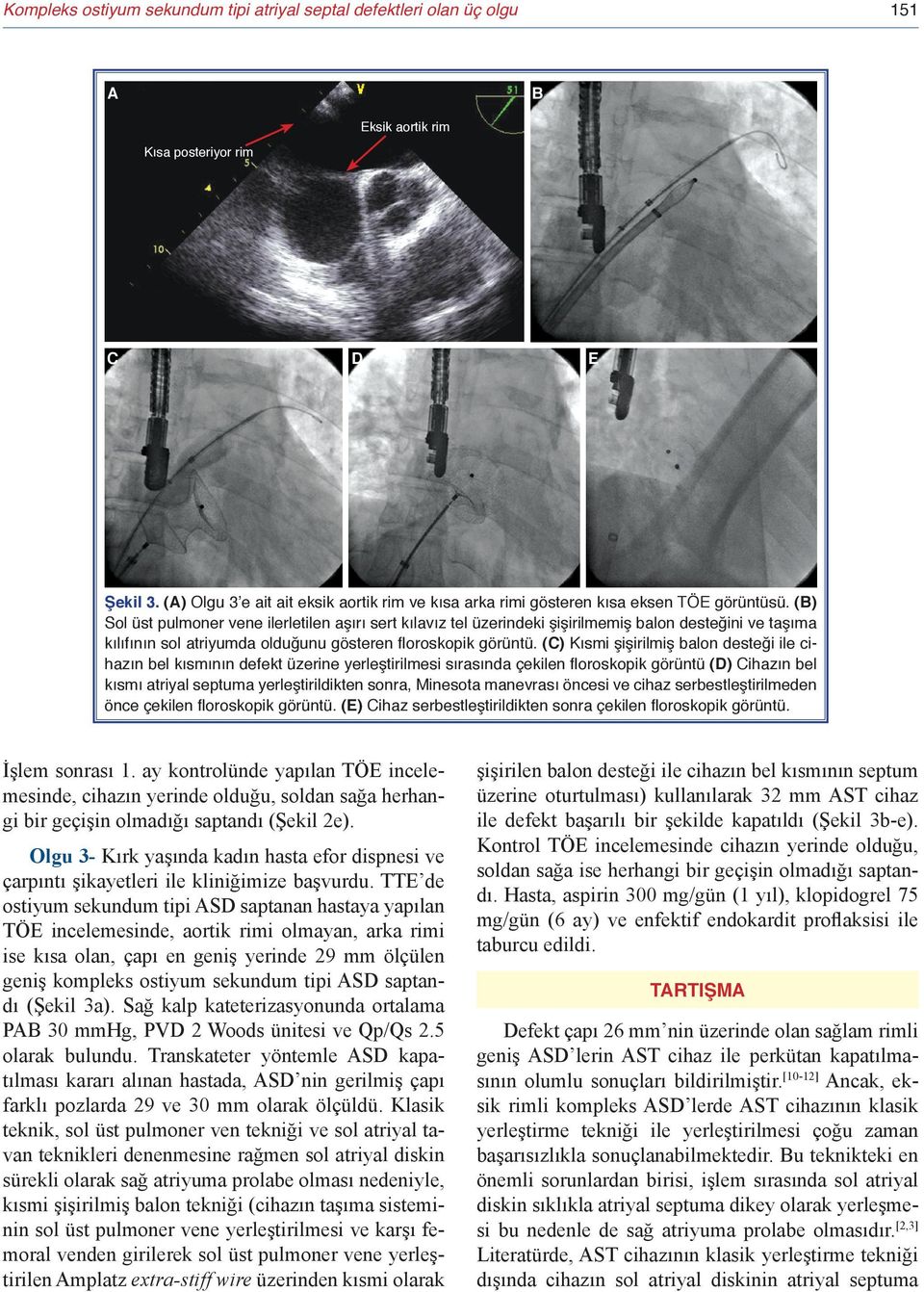 (B) Sol üst pulmoner vene ilerletilen aşırı sert kılavız tel üzerindeki şişirilmemiş balon desteğini ve taşıma kılıfının sol atriyumda olduğunu gösteren floroskopik görüntü.