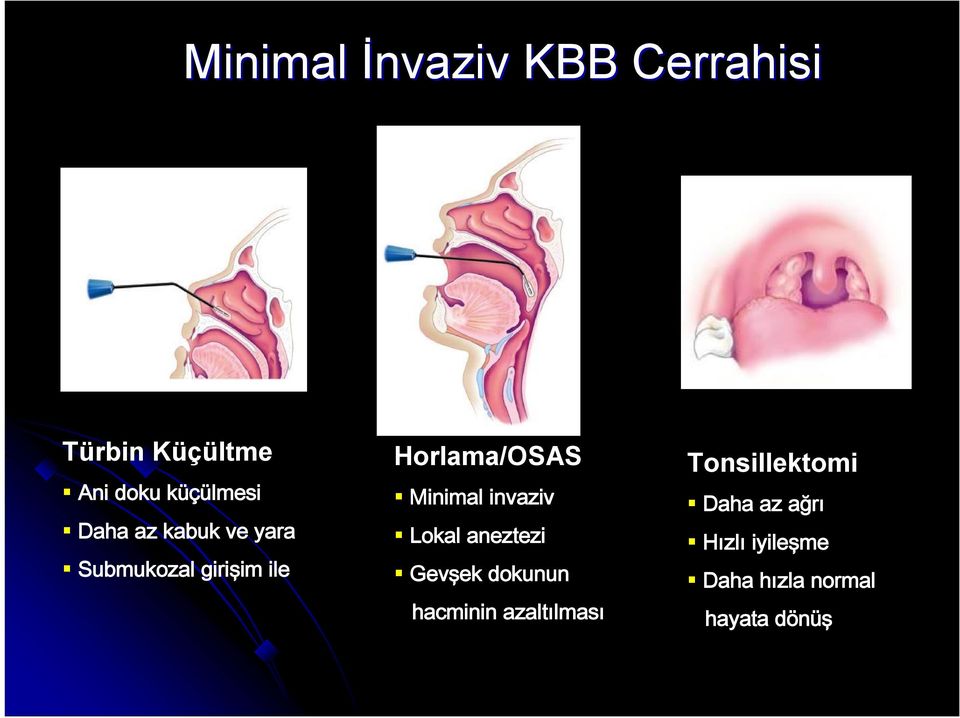 invaziv Lokal aneztezi Gevşek dokunun hacminin azaltılması