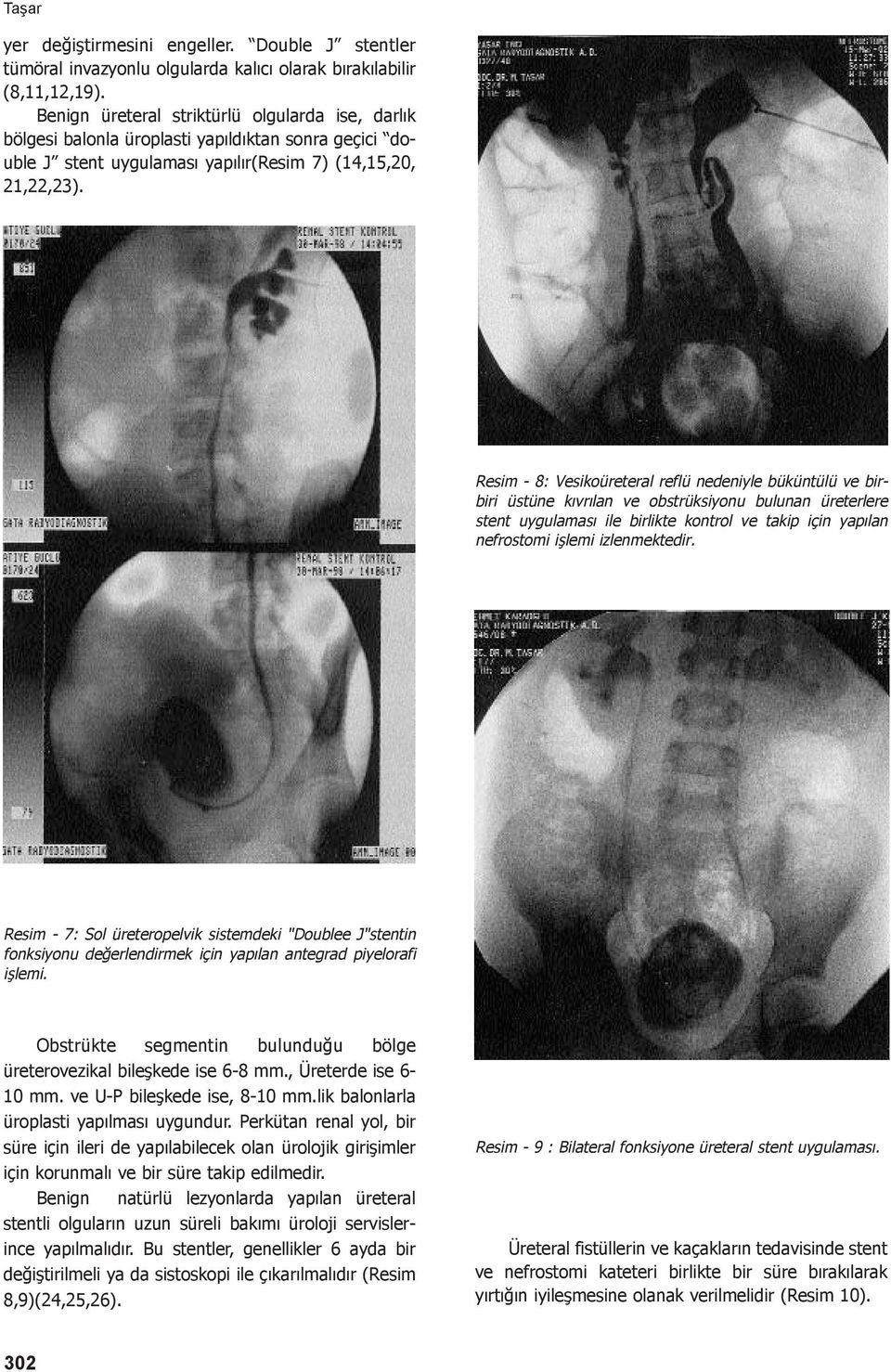 Resim - 8: Vesikoüreteral reflü nedeniyle büküntülü ve birbiri üstüne kıvrılan ve obstrüksiyonu bulunan üreterlere stent uygulaması ile birlikte kontrol ve takip için yapılan nefrostomi işlemi